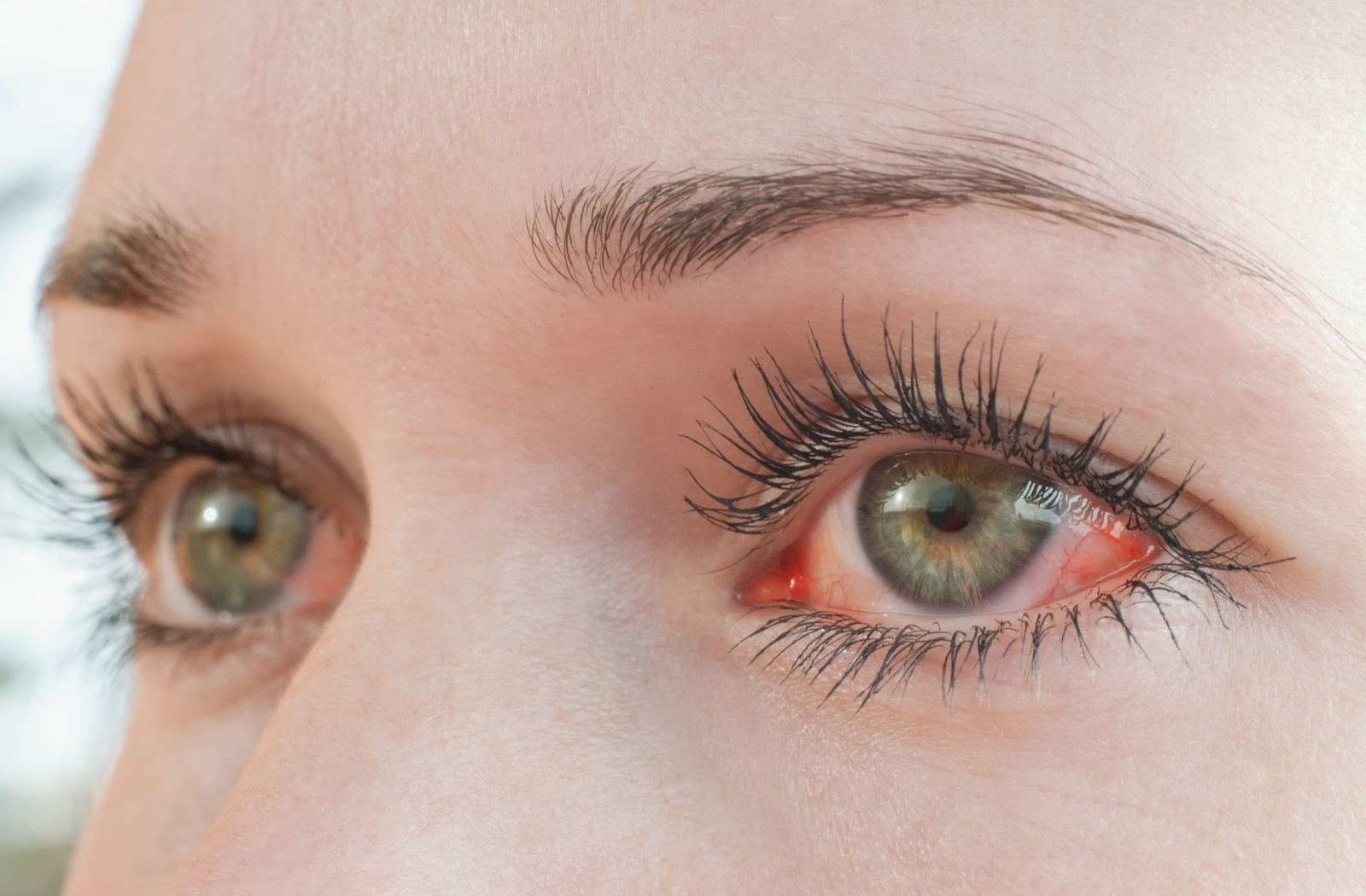 Close-up of a person’s eyes showing redness, a common symptom associated with pink eye or other eye conditions.